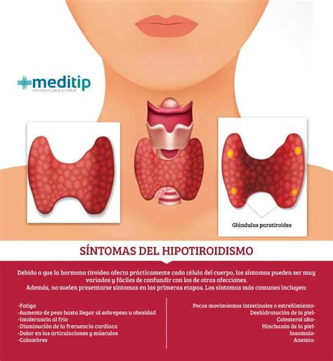 El tratamiento del hipotiroidismo y sus deficiencias   Meditip