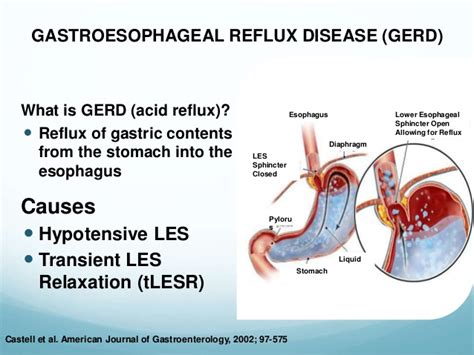 Eletro Stimulation of Lower Esophageal Sphincter on GERD ...