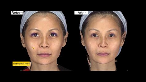 Ellanse procedure at Shang Li Dermatologic & Aesthetic ...