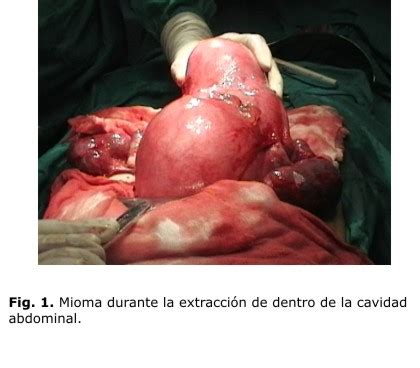 Embarazo ectopico ovarico tratamiento