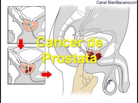 ¿En el caso de cáncer de próstata avanzado qué opciones ...
