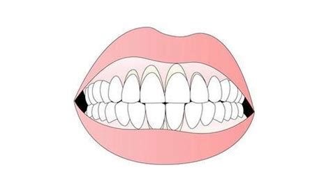 ¿En qué consiste el mantenimiento periodontal?
