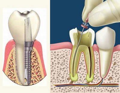 ¿En qué consiste la endodoncia? | Clínica Dental Deltadent