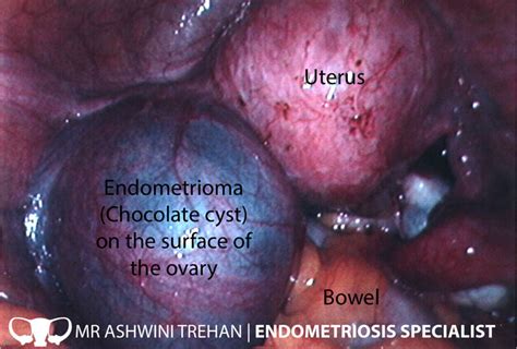 Endometriosis Diagnosis   Endometriosis Specialist