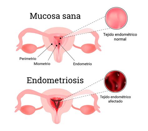 Endometriosis, qué es y qué lesiones provoca