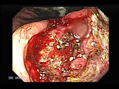 Endoscopia: Cáncer Gástrico Ulcerado   YouTube