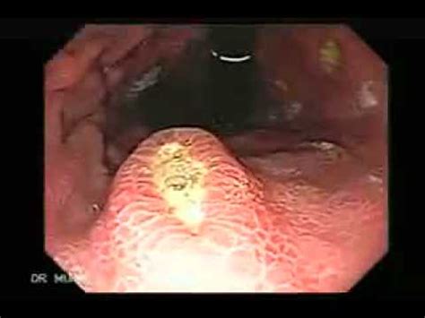 Endoscopia de múltiples ulceras en el estómago | Cáncer ...
