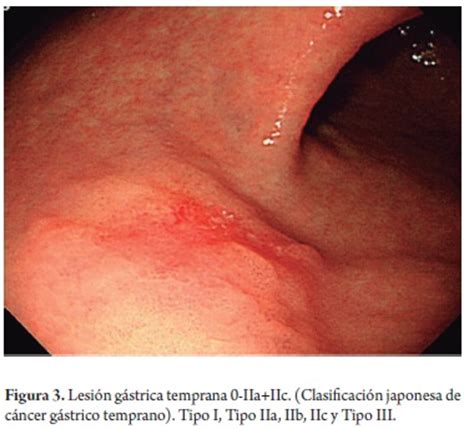 Endoscopic submucosal dissection  ESD  for early gastric ...