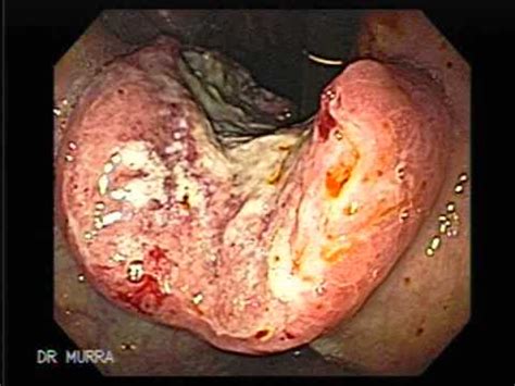 Endoscopy Ulcerated Stomach Cancer   YouTube