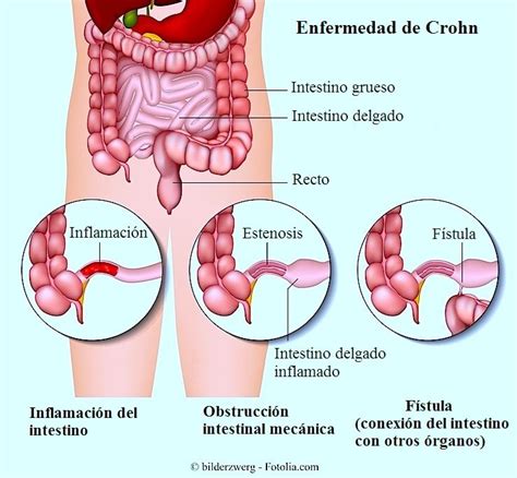 Enfermedad de Crohn, en niños, síntomas, dieta y ...