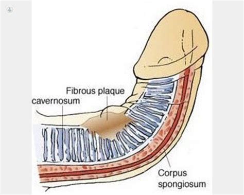 Enfermedad de Peyronie: la incurvación del pene