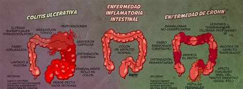 ENFERMEDAD INFLAMATORIA INTESTINAL: COLITIS ULCEROSA Y ...