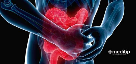 Enfermedad inflamatoria intestinal: tipos y tratamiento ...