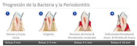 Enfermedad periodontal: tratamiento y prevención ...