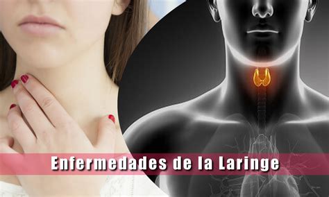 Enfermedades de la Laringe   Laringitis   Lesiones ...