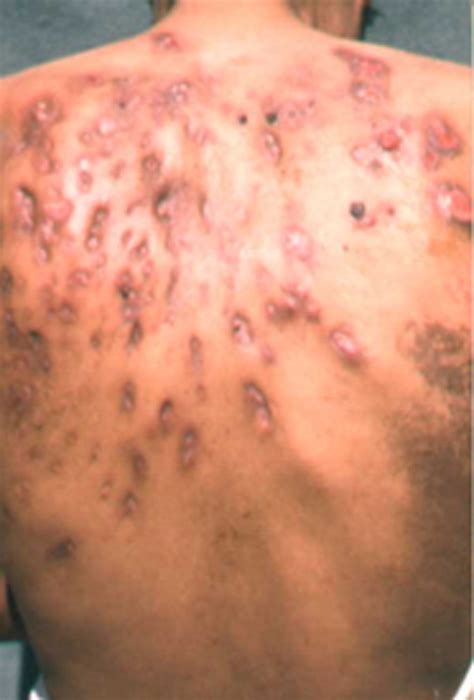 Enfermedades de la piel; Dermatosis