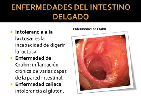 Enfermedades del intestino delgado   Intestino delgado