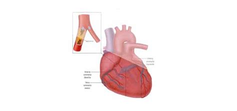 Enfermedades del sistema circulatorio » Blog de Biología