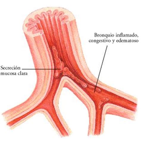 Enfermedades del sistema respiratorio: Bronquitis