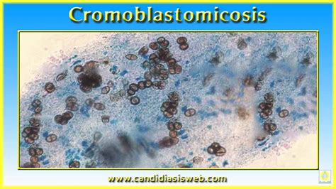 Enfermedades por hongos   Cromoblastomicosis