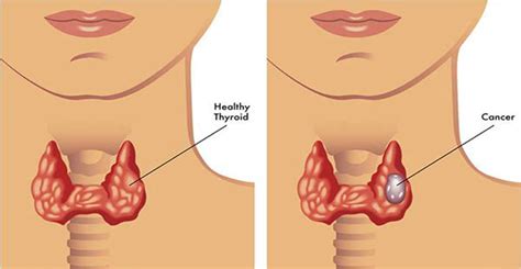 Enfermedades que afectan la glándula tiroides   Salud Diaria