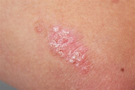 enfermedades raras de la piel | Salud180
