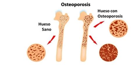 Enfermedades,Causas,TratamientosdelosSistemas: Sistema Oseo