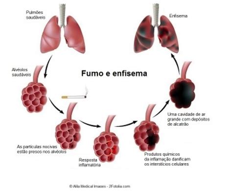 Enfisema pulmonar, sintomas,tratamento e cuidados