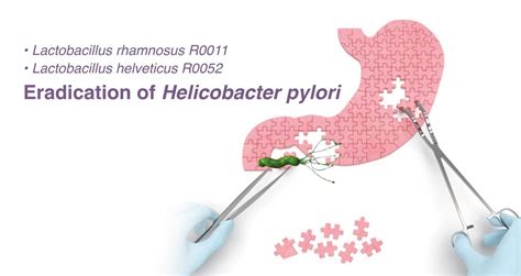 Eradication of Helicobacter Pylori | Vitamode