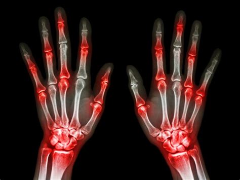 ¿Es lo mismo la artrosis que la artritis?   Enfermedades