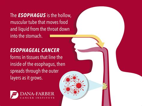 esophageal cancer causes and symptoms   DriverLayer Search ...