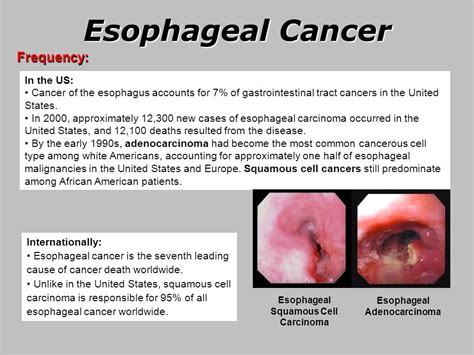 Esophageal Cancer.   ppt video online download