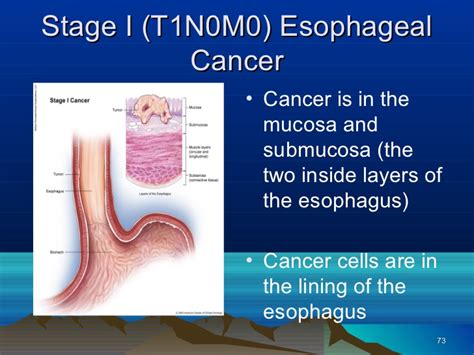 Esophageal Cancer Related Keywords   Esophageal Cancer ...