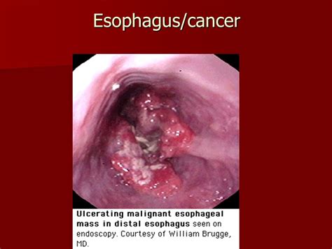 Esophageal cancer SCC Adenocarcinoma   ppt video online ...