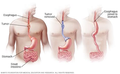 Esophageal cancer surgery   Mayo Clinic