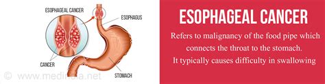 Esophageal Cancer   Types, Risk factors, Symptoms ...