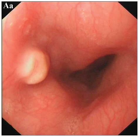 Esophageal granular cell tumor: Clinical, endoscopic and ...