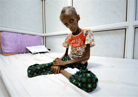Esta es la imagen del hambre y la malnutrición en Yemen ...