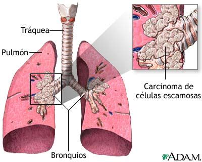 Estadiaje del cáncer de pulmón: novedades. – Servicio de ...