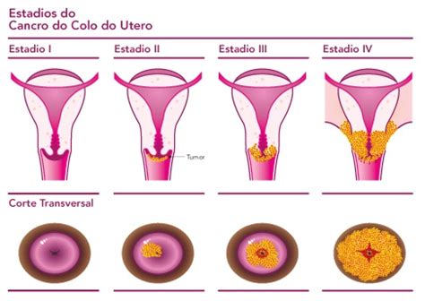 Estadiamento cancro colo do útero | CUF