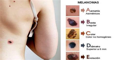 Estos son los 5 síntomas del cáncer de piel ...