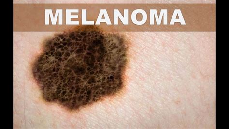 Estos son los síntomas del melanoma o cáncer de piel que ...