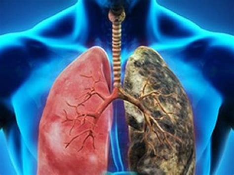 EUA inicia campaña de detección de cáncer pulmonar | EL DEBATE