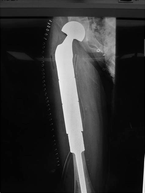 Ewing Sarcoma : Bone Tumor Cancer : Tumors of the Bone