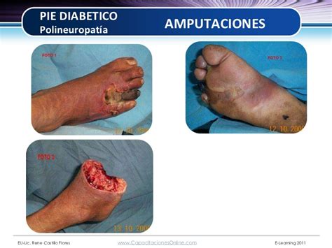 Examen clinico del pie diabetico 2008