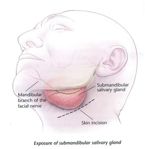 Excision submandibular gland  removing the large saliva ...