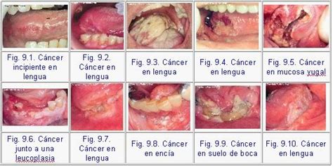 Experiencias en el area de la salud: Tarea #13 CANCER DE ...
