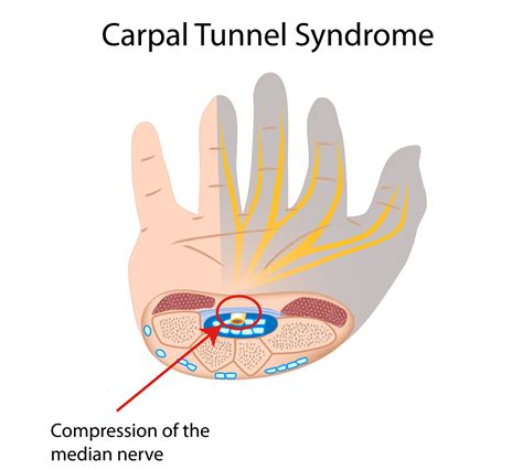 Explainer: what is carpal tunnel syndrome and what happens ...