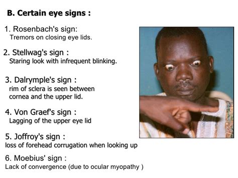 Eye signs in Graves Disease | World Surgery Forum