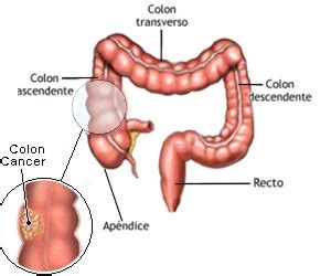 Factores de riesgo del cáncer de colon, Porqué da cáncer ...